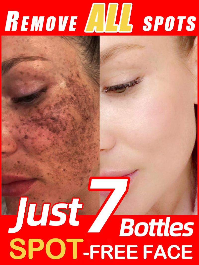 Lighten Freckles Melasma, Faci - Luxury Skincare Essence 评论和价格